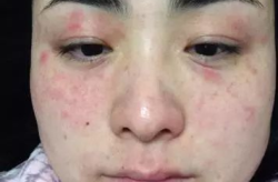 脸部过敏症状,常见表现与应对策略
